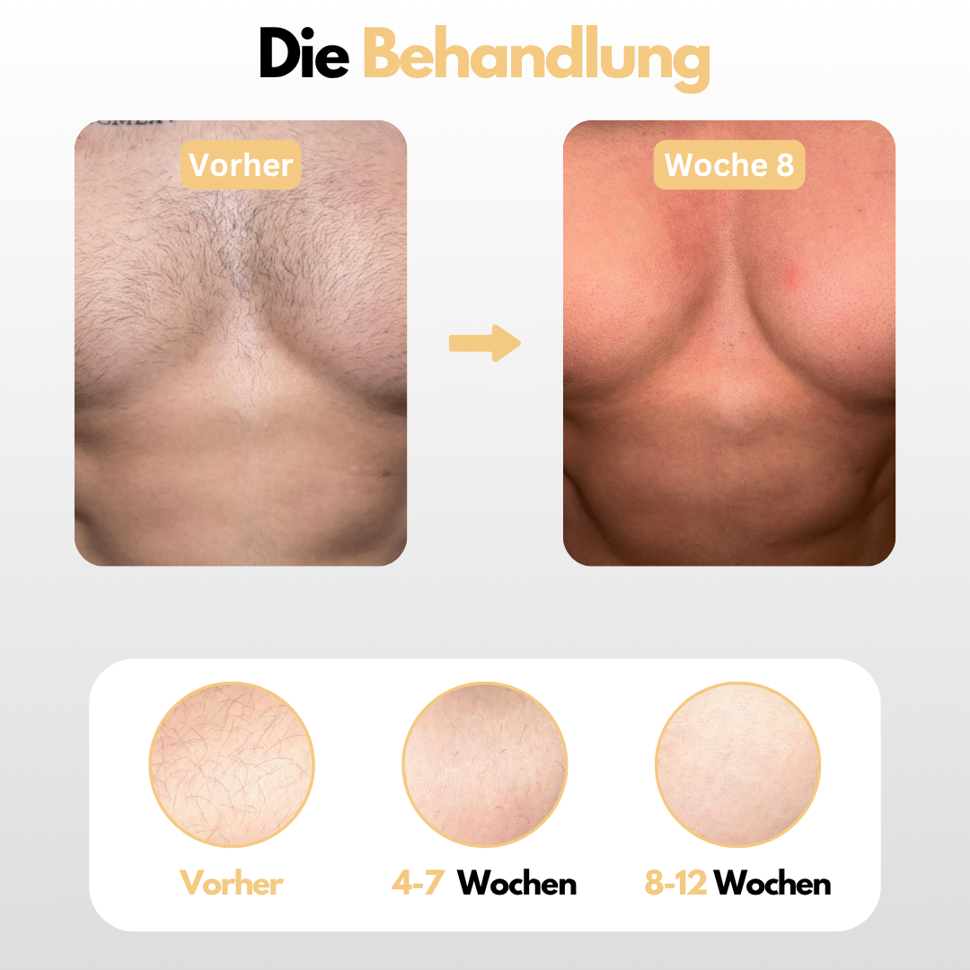Dauerhafte Entfernung von Körper & Intimbehaarung