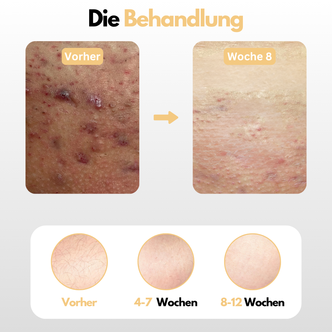 Dauerhafte Entfernung von Körper & Intimbehaarung