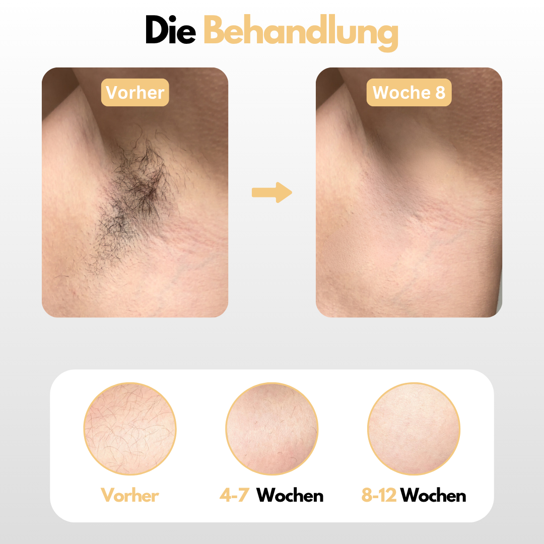 Dauerhafte Entfernung von Körper & Intimbehaarung