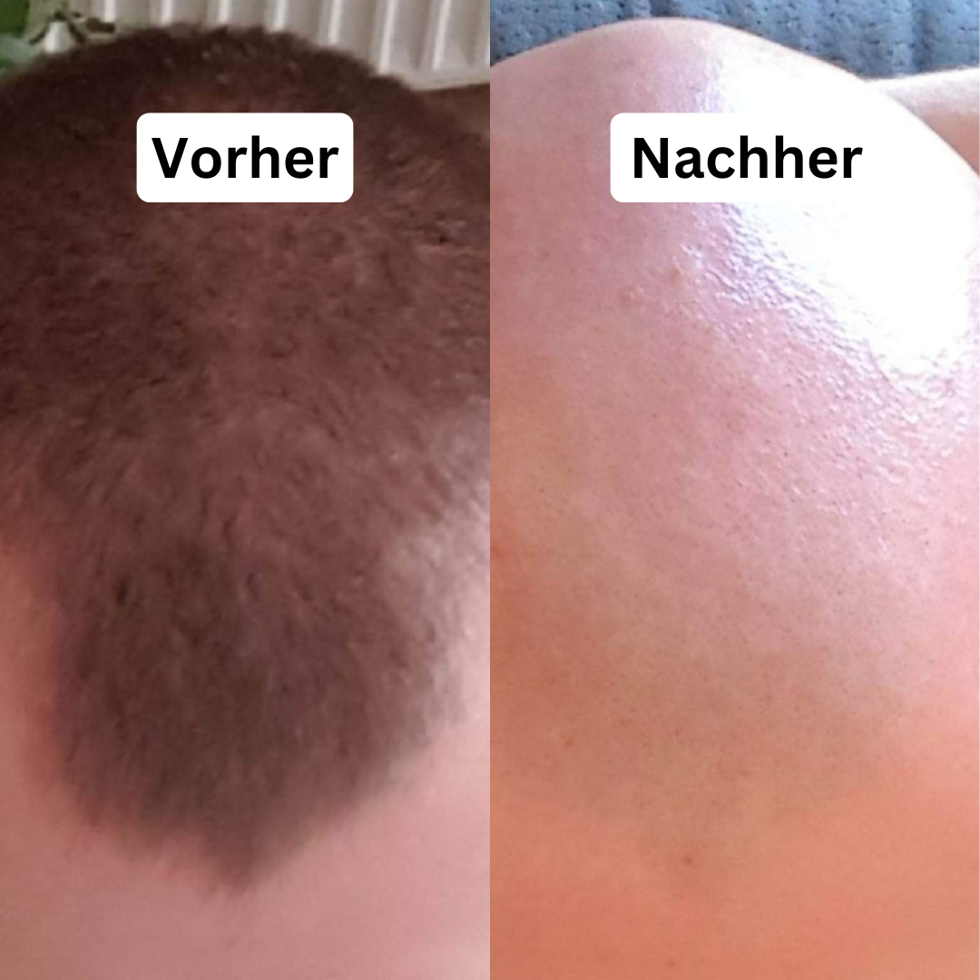 Der BoldHead - Der Rasierer für deine Glatze